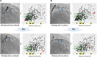 Robust Association Between Changes in Coronary Flow Capacity Following Percutaneous Coronary Intervention and Vessel-Oriented Outcomes and the Implication for Clinical Practice